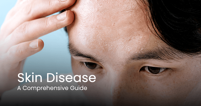 Biologic Therapy For Psoriasis Raleigh Nc