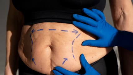 Abdominoplasty
