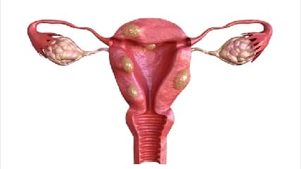 Uterine Fibroids