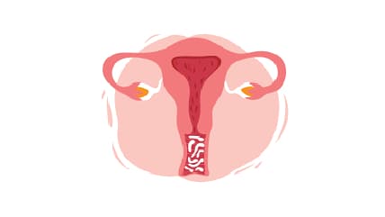 What Causes Vaginal Yeast Infection?