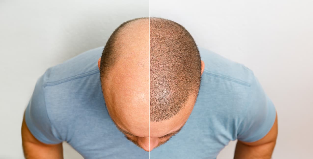 From Bald to Bold: Everything You Need to Know About Hair Transplants