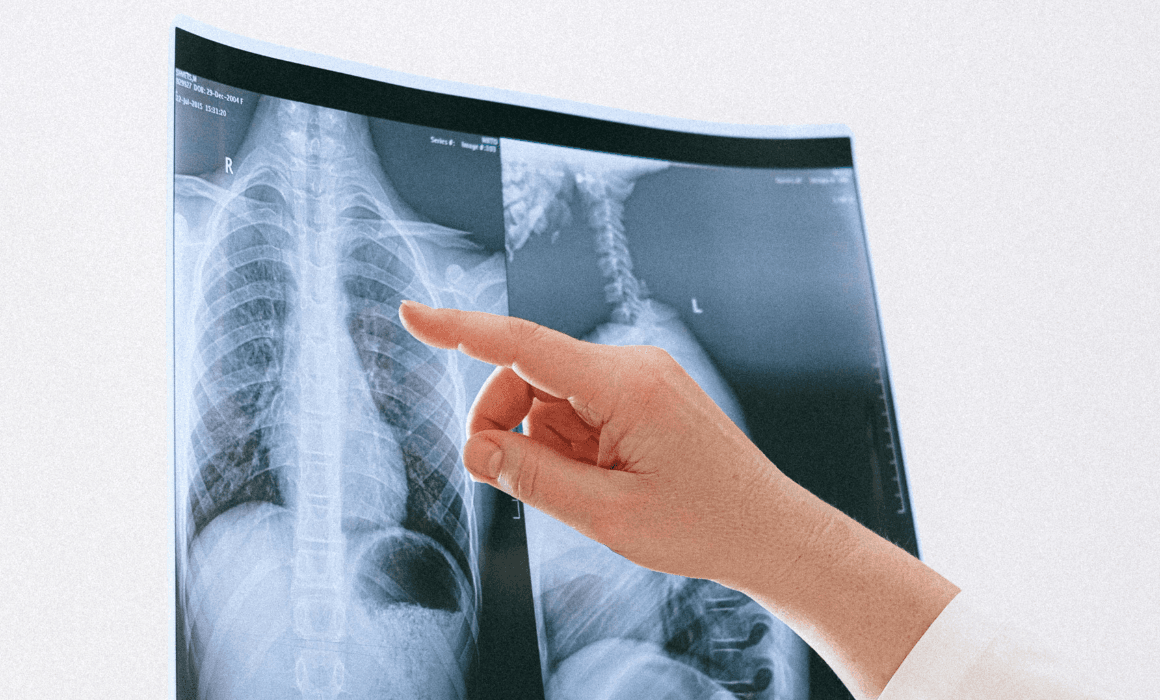 Early Detection of Lung Cancer: Why It Matters ?